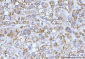 IHC staining of FFPE human liver cancer tissue with Hamartin antibody. HIER: boil tissue sections in pH8 EDTA for 20 min and allow to cool before testing.