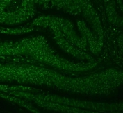 Immunofluorescent staining of FFPE human colon cancer tissue with SNRNP27 antibody (green). HIER: steam section in pH8 EDTA buffer for 20 min.