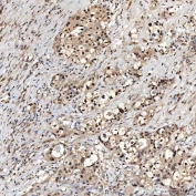 IHC staining of FFPE human appendix adenocarcinoma tissue with SNRNP27 antibody. HIER: boil tissue sections in pH8 EDTA for 20 min and allow to cool before testing.