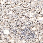 IHC staining of FFPE human prostate adenocarcinoma tissue with SNRNP27 antibody. HIER: boil tissue sections in pH8 EDTA for 20 min and allow to cool before testing.
