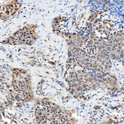 IHC staining of FFPE human urothelial carcinoma tissue with SNRNP27 antibody. HIER: boil tissue sections in pH8 EDTA for 20 min and allow to cool before testing.