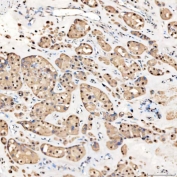 IHC staining of FFPE human right renal oncocytoma tissue with SNRNP27 antibody. HIER: boil tissue sections in pH8 EDTA for 20 min and allow to cool before testing.