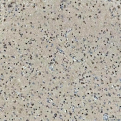 IHC staining of FFPE human glioblastoma tissue with SNRNP27 antibody. HIER: boil tissue sections in pH8 EDTA for 20 min and allow to cool before testing.