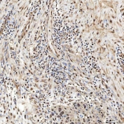 IHC staining of FFPE human esophageal squamous carcinoma tissue with SNRNP27 antibody. HIER: boil tissue sections in pH8 EDTA for 20 min and allow to cool before testing.