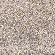 IHC staining of FFPE human diffuse large B cell lymphoma tissue with SNRNP27 antibody. HIER: boil tissue sections in pH8 EDTA for 20 min and allow to cool before testing.