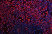Immunofluorescent staining of FFPE human lung cancer tissue with Small ribosomal subunit protein uS7 antibody (red) and DAPI nuclear stain (blue). HIER: steam section in pH8 EDTA buffer for 20 min.