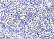 IHC staining of FFPE human lung adenocarcinoma tissue with Small ribosomal subunit protein uS7 antibody. HIER: boil tissue sections in pH8 EDTA for 20 min and allow to cool before testing.