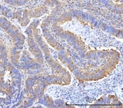 IHC staining of FFPE human intestinal cancer tissue with ArgRS antibody. HIER: boil tissue sections in pH8 EDTA for 20 min and allow to cool before testing.