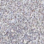 IHC staining of FFPE human diffuse large B cell lymphoma tissue with SNRNP200 antibody. HIER: boil tissue sections in pH8 EDTA for 20 min and allow to cool before testing.