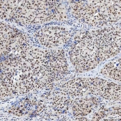 IHC staining of FFPE human liver cancer tissue with SNRNP200 antibody. HIER: boil tissue sections in pH8 EDTA for 20 min and allow to cool before testing.