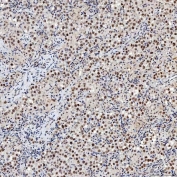 IHC staining of FFPE human testicular seminoma tissue with SNRNP200 antibody. HIER: boil tissue sections in pH8 EDTA for 20 min and allow to cool before testing.