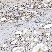 IHC staining of FFPE human prostate adenocarcinoma tissue with SNRNP200 antibody. HIER: boil tissue sections in pH8 EDTA for 20 min and allow to cool before testing.