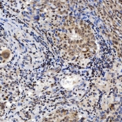 IHC staining of FFPE human lung adenocarcinoma tissue with SNRNP200 antibody. HIER: boil tissue sections in pH8 EDTA for 20 min and allow to cool before testing.
