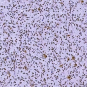 IHC staining of FFPE human glioblastoma tissue with SNRNP200 antibody. HIER: boil tissue sections in pH8 EDTA for 20 min and allow to cool before testing.