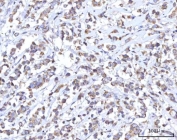 IHC staining of FFPE human breast cancer tissue with RBFA antibody. HIER: boil tissue sections in pH8 EDTA for 20 min and allow to cool before testing.