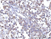 IHC staining of FFPE human undifferentiated carcinoma of pancreas tissue with RBFA antibody. HIER: boil tissue sections in pH8 EDTA for 20 min and allow to cool before testing.