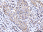 IHC staining of FFPE human appendix adenocarcinoma tissue with RBFA antibody. HIER: boil tissue sections in pH8 EDTA for 20 min and allow to cool before testing.