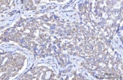 IHC staining of FFPE human lung squamous cell carcinoma tissue with RBFA antibody. HIER: boil tissue sections in pH8 EDTA for 20 min and allow to cool before testing.