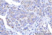 IHC staining of FFPE human liver cancer tissue with RBFA antibody. HIER: boil tissue sections in pH8 EDTA for 20 min and allow to cool before testing.