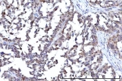 IHC staining of FFPE human ovary serous carcinoma tissue with RANBP2 antibody. HIER: boil tissue sections in pH8 EDTA for 20 min and allow to cool before testing.