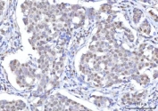 IHC staining of FFPE human esophageal squamous carcinoma tissue with RANBP2 antibody. HIER: boil tissue sections in pH8 EDTA for 20 min and allow to cool before testing.