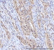 IHC staining of FFPE human appendix adenocarcinoma tissue with RANBP2 antibody. HIER: boil tissue sections in pH8 EDTA for 20 min and allow to cool before testing.