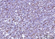 IHC staining of FFPE human diffuse large B cell lymphoma tissue with RNF34 antibody. HIER: boil tissue sections in pH8 EDTA for 20 min and allow to cool before testing.