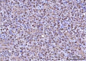 IHC staining of FFPE human testicular seminoma tissue with RNF34 antibody. HIER: boil tissue sections in pH8 EDTA for 20 min and allow to cool before testing.