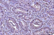 IHC staining of FFPE human rectum adenocarcinoma tissue with RNF34 antibody. HIER: boil tissue sections in pH8 EDTA for 20 min and allow to cool before testing.