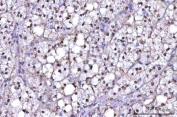 IHC staining of FFPE human adrenocortical adenoma tissue with RNF34 antibody. HIER: boil tissue sections in pH8 EDTA for 20 min and allow to cool before testing.