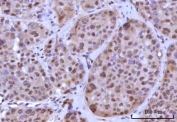 IHC staining of FFPE human liver cancer tissue with RNF40 antibody. HIER: boil tissue sections in pH8 EDTA for 20 min and allow to cool before testing.