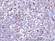 IHC staining of FFPE human lung adenocarcinoma tissue with RNF40 antibody. HIER: boil tissue sections in pH8 EDTA for 20 min and allow to cool before testing.