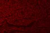 Immunofluorescent staining of FFPE human lung cancer tissue with RNF40 antibody (red). HIER: steam section in pH8 EDTA buffer for 20 min.