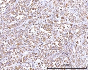 IHC staining of FFPE human lung adenocarcinoma tissue with RPN1 antibody. HIER: boil tissue sections in pH8 EDTA for 20 min and allow to cool before testing.
