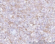 IHC staining of FFPE human testicular seminoma tissue with RPN1 antibody. HIER: boil tissue sections in pH8 EDTA for 20 min and allow to cool before testing.