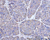 IHC staining of FFPE human liver cancer tissue with RPN1 antibody. HIER: boil tissue sections in pH8 EDTA for 20 min and allow to cool before testing.