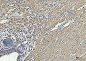 IHC staining of FFPE human colon cancer tissue with TP53I13 antibody. HIER: boil tissue sections in pH8 EDTA for 20 min and allow to cool before testing.