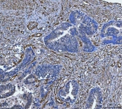 IHC staining of FFPE human endometrial adenocarcinoma tissue with TP53I13 antibody. HIER: boil tissue sections in pH8 EDTA for 20 min and allow to cool before testing.