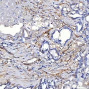 IHC staining of FFPE human ovarian cancer tissue with TP53I13 antibody. HIER: boil tissue sections in pH8 EDTA for 20 min and allow to cool before testing.