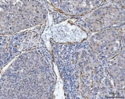 IHC staining of FFPE human liver cancer tissue with TP53I13 antibody. HIER: boil tissue sections in pH8 EDTA for 20 min and allow to cool before testing.