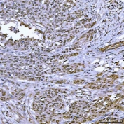IHC staining of FFPE human ovarian serous adenocarcinoma tissue with TOP3B antibody. HIER: boil tissue sections in pH8 EDTA for 20 min and allow to cool before testing.
