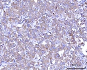 IHC staining of FFPE human lung adenocarcinoma tissue with RPS25 antibody. HIER: boil tissue sections in pH8 EDTA for 20 min and allow to cool before testing.