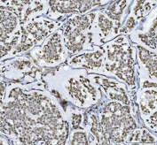 IHC staining of FFPE human breast cancer tissue with RTCB antibody. HIER: boil tissue sections in pH8 EDTA for 20 min and allow to cool before testing.