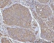 IHC staining of FFPE human liver cancer tissue with OCRL-1 antibody. HIER: boil tissue sections in pH8 EDTA for 20 min and allow to cool before testing.