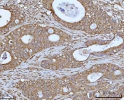 IHC staining of FFPE human colon adenocarcinoma tissue with OCRL-1 antibody. HIER: boil tissue sections in pH8 EDTA for 20 min and allow to cool before testing.