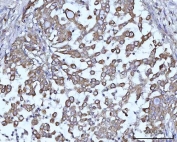 IHC staining of FFPE human lung adenocarcinoma tissue with SSBP1 antibody. HIER: boil tissue sections in pH8 EDTA for 20 min and allow to cool before testing.