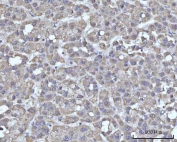 IHC staining of FFPE human liver cancer tissue with SSBP1 antibody. HIER: boil tissue sections in pH8 EDTA for 20 min and allow to cool before testing.