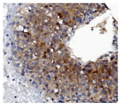 IHC staining of FFPE human liver cancer tissue with GSDMD antibody. HIER: boil tissue sections in pH8 EDTA for 20 min and allow to cool before testing.