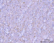 IHC staining of FFPE human testicular seminoma tissue with PITPNB antibody. HIER: boil tissue sections in pH8 EDTA for 20 min and allow to cool before testing.