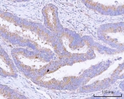 IHC staining of FFPE human colon adenocarcinoma tissue with PITPNB antibody. HIER: boil tissue sections in pH8 EDTA for 20 min and allow to cool before testing.